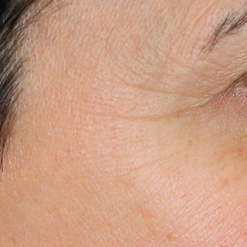 INTENSE HYDRATION - Before