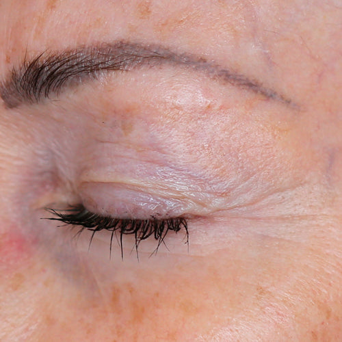 COMPLEXE TENSEUR YEUX - Before