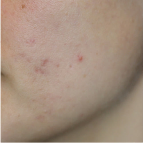 GLYCOLIC ACID LOTION 10% - After