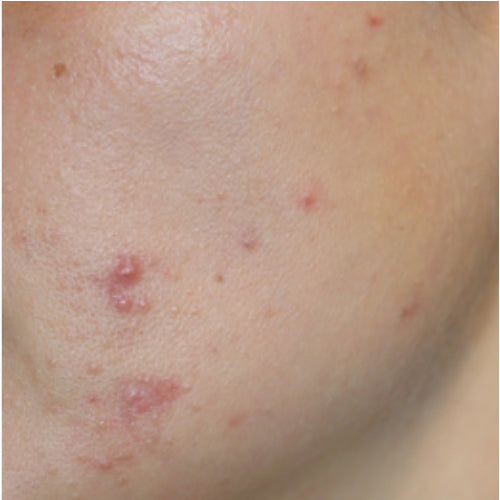 GLYCOLIC ACID LOTION 10% - Before
