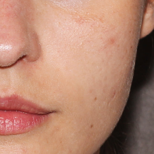GLYCOLIC ACID NIGHT 5% - Before