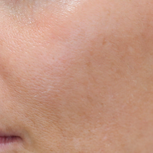 TRIPLE ACTION PEEL - After