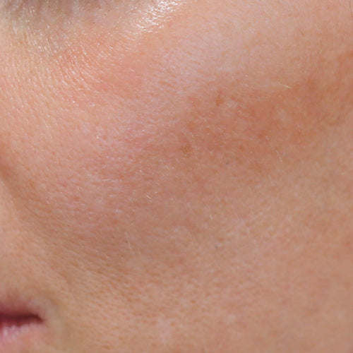 TRIPLE ACTION PEEL - Before