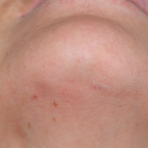 POST-TREATMENT 1 - After