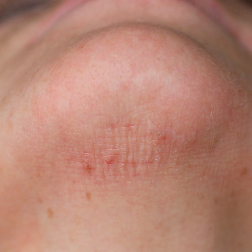 POST-TREATMENT 1 - Before
