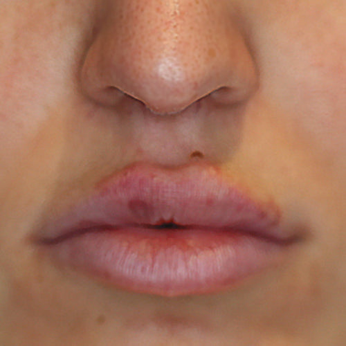 PRE/POST INJECT - After
