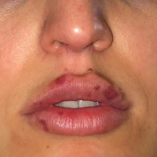 PRE/POST INJECT - Before