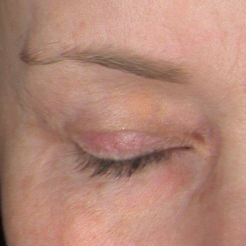 PRE/POST-TREATMENT 2 - Before