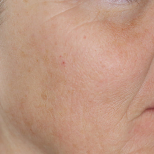 BIOLIFT HA - After