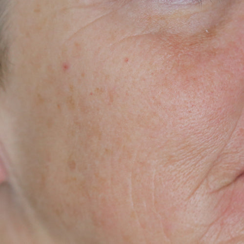 BIOLIFT HA - Before