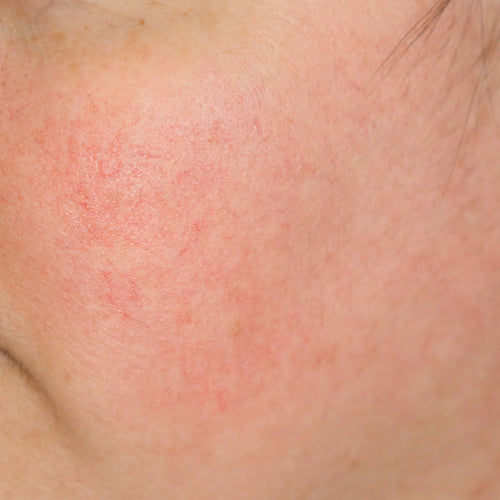 REDNESS REDUCER - After
