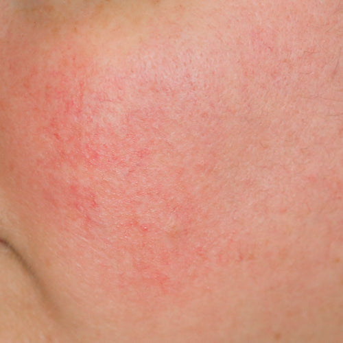 REDNESS REDUCER - Before