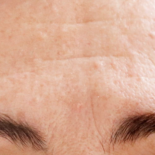 RETINOL 0,5% - Before