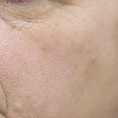 RETINOL 1% - After