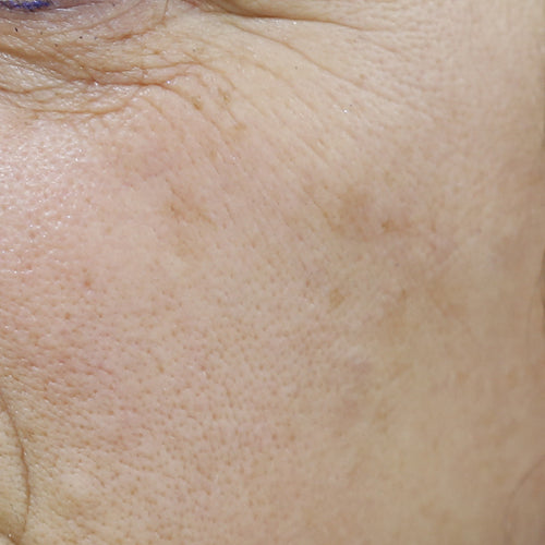 RETINOL 1% - Before
