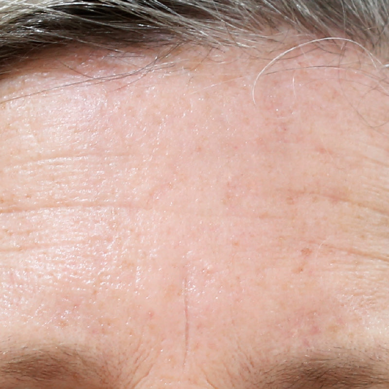 PRO-COLLAGEN - After