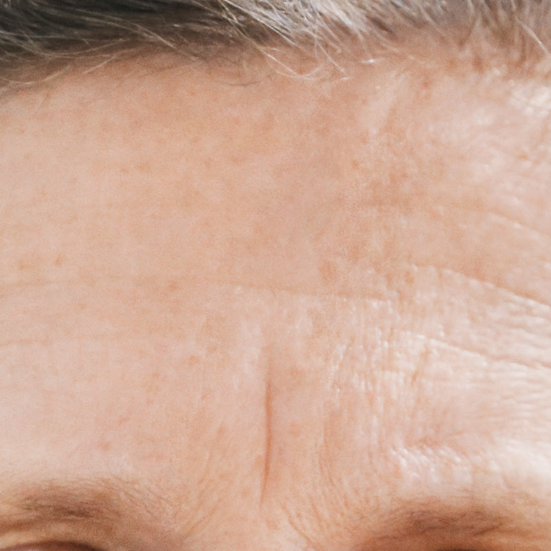 PRO-COLLAGEN - Before